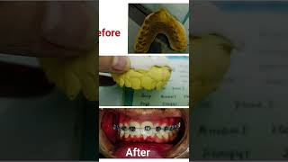 Orthodontics treatment 45 month progress ortholearning orthodontics [upl. by Yorled262]