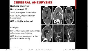 VASCULAR CNS LESIONS 2 Prof Hesham elshaikh [upl. by Gwennie]