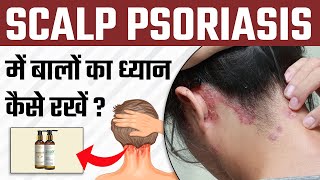 Scalp Psoriasis में Flaking और Hair fall को कम कैसे करें   Tips to Control Flaking in Psoriasis [upl. by Selinski511]