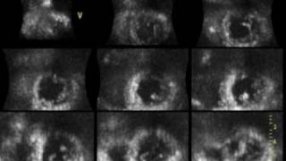 ACUTE MYOCARDIAL INFARCTION ANTEROSEPTAL 3D ECHOCARDIOGRAPHY cardiac ultrasound [upl. by Ahsekim]