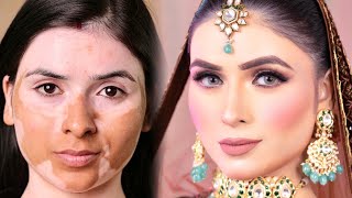 Vitiligo skin makeup tutorial by Sanya and Shifa [upl. by Ettenej]