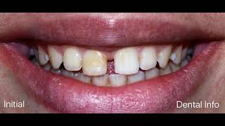 Diastema Closure Step By Step [upl. by Bratton]