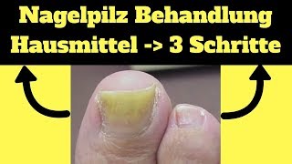 Nagelpilz Behandlung Hausmittel ✔ 3 Schritte um ekligen Nagelpilz loszuwerden [upl. by Yanehc]