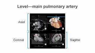 How to identify normal heart structures on a cardiac CT scan [upl. by Vullo]