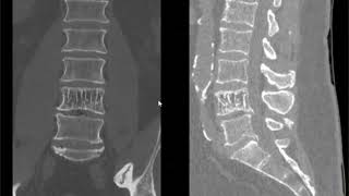 Spine lecture hemangioma of spine [upl. by Carine843]