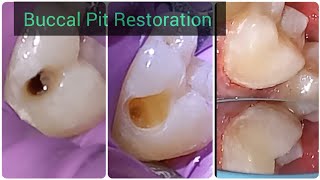 Composite Restoration of Buccal Pit under Rubber Dam  Buccal Pit Cavity Preparation [upl. by Aicenra]