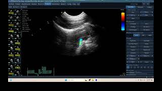 IQ 302 TCD BRAIN ICP CPP ECHOPAC ANALYSIS ULTRASOUND 3 [upl. by Pestana]