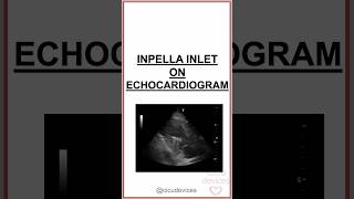 IMPELLA CP INLET ON ECHOCARDIOGRAM impella [upl. by Yecnuahc]