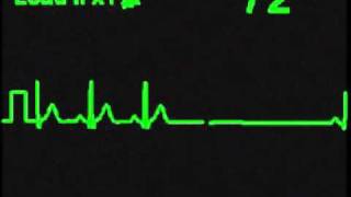 Sinus Exit Block [upl. by Ennirok]