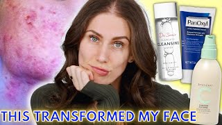 How To Double Cleanse With Acne Cloud Cushions amp Micellar Water [upl. by Naugal339]