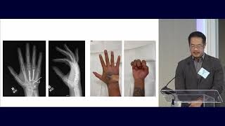 15 Metacarpal and Phalangeal Fractures Nicolas Lee MD 020 [upl. by Reggis829]