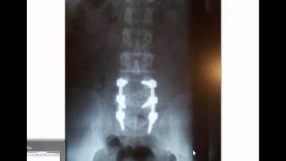 Lumbar fusion 7 months post op [upl. by Scott]