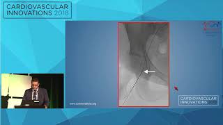 CVI2018 Session Back to the PCI basics Mt Sopris Rm July 28 1030 am [upl. by Soloma]