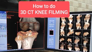 How to do 3D CT Knee Filming Protocol [upl. by Bekah922]