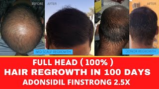 Grade 7 To Normal In 100 days Best Hair Regrowth Treatment For Male [upl. by Dru]