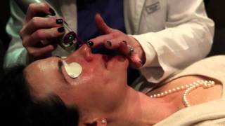 Laser treatment for Rosacea Birmingham Alabama  Cosmetic Dermatology [upl. by Auqenes]