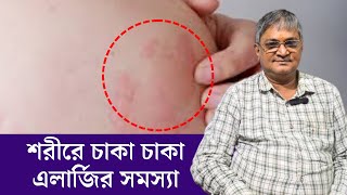 Urticaria  Causes Symptoms Treatment  Skin Rash  এলার্জি থেকে মুক্তির উপায়  ত্বকে চুলকানি [upl. by Jayme]