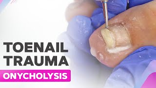 Toenail Trauma  Onycholysis  Cleanup [upl. by Zeuqirdor756]