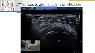 Calcification dépaule ponction lavage sous guidage échographique 2ème vidéo [upl. by Inoue]