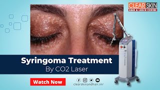 CO2 Laser treatment for Syringomas  Best Laser Treatment For Syringomas  DrNKailash  Kurnool [upl. by Kellda]