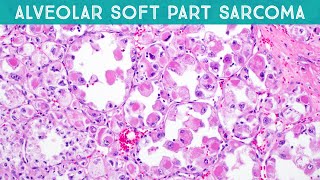 Alveolar soft part sarcoma explained in 5 minutes basic soft tissue pathology [upl. by Audi]