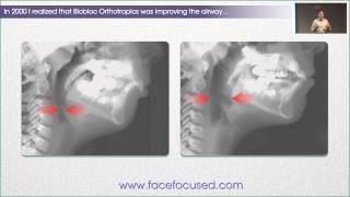 The Case for Biobloc Improving the Airway  William M Hang DDS MSD [upl. by Odlanor885]