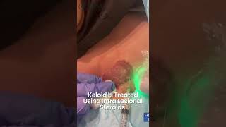 Keloid Scar Treatment by Dr Fazeela Abbasi [upl. by Esiuqcaj666]