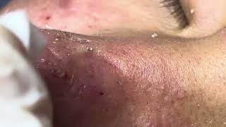 Acne treatment Thu 90 Da Nang  new 112024 [upl. by Pendleton]