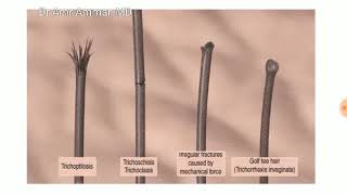 Trichoscopy basic Part 3 Amr Ammar MD [upl. by Arlan]