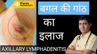 बगल की गाँठ  Axillary Lymphadenitis  Armpit Lymph Nodes Swollen  Swollen Lymph Nodes Treatment [upl. by Artima133]