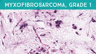 Myxofibrosarcoma grade 1low grade explained in 5 minutes dermpath dermatology sarcoma pathology [upl. by Ellekcim949]