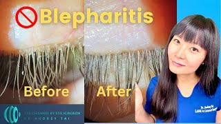 Best Blepharitis Treatments at Home  Simple amp Effective  Step by Step Guide Eye Surgeon Explains [upl. by Anilegna358]