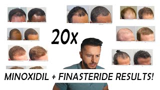 20 Finasteride and Minoxidil before and after Results NW2  NW56 [upl. by Ainer36]