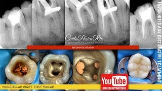 one visit endodontic retreatment mandibular molar rebilda dc spesialis konservasi gigi [upl. by Hobart]