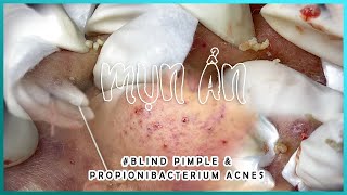 Big Cystic Acne Blackheads Extraction Blackheads amp Milia Whiteheads Removal Pimple Popping [upl. by Avihs]