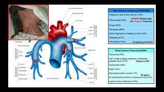 Wells Criteria for Pulmonary Embolisms PEs EXPLAINED [upl. by Notsnarc]