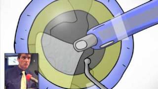 Cartoon Cataract Surgery [upl. by Lundquist]