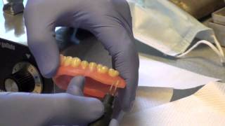 Denture Soft Reline Part 2 [upl. by Rustice]