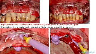 ALL ON 4 SUPERIOR COM IMPLANTES IMEDIATOS APÓS EXTRAÇÕES [upl. by Dennis873]