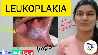 LEUKOPLAKIA  PREMALIGNANT LESION [upl. by Enomahs571]