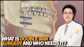 What is Double Jaw Surgery how it works and who needs this cosmetic procedure [upl. by Deaner541]