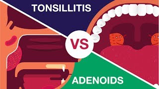 What is Adenoids and Tonsillitis Complete Video [upl. by Mccormac]