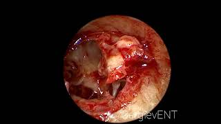 Endoscopic tympanosclerosis and atresia EAC surgery [upl. by Ordnaxela]