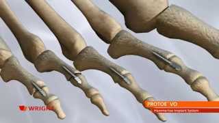 PROTOE™ VO Hammertoe Implant System Animation [upl. by Lorrimer136]