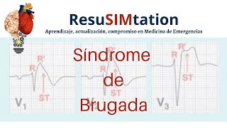 Síncope Síndrome de Brugada [upl. by Danell294]