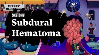 Subdural Hematoma SAH Part 1  Sketchy Medical  USMLE Step 1 [upl. by Lanevuj]