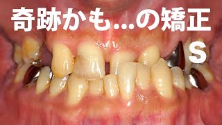 ガチャ歯 歯が悪い GVBDO Before amp After Braces Time Lapse 269 死にたいほど歯が悪かった人が復活した歯列矯正２６９日の記録。 [upl. by Far]