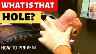 HOW WE TREAT DIABETIC WOUNDS [upl. by Marsden]