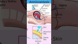 Amniocentesis amniocentesis kya hota h amniocentesis NEETUG Nursing pregnancy childbirth [upl. by Adile]