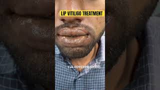 100 lip VITILIGO PERMANENT TREATMENT VITILIGO lip SAFED DAAG  lipvitiligotreatment shorts cure [upl. by Barron3]